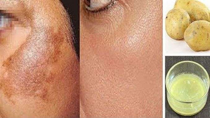 home-remedy-for-pigmentation